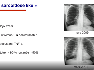 Granulomes et médicaments