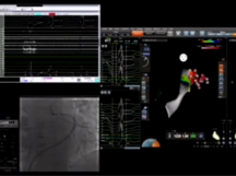 Great cardiac vein (GCV) VT Ablation in coronary sinus