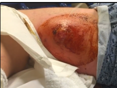 Gross Cellulitis! MRSA, Cysts, Pimples, Surgery and Infection