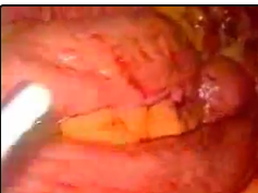 Gunshot Wound to the Abdomen: Laparoscopic Exploration and Repair of Small Bowel Injury Gunshot Wound to the Abdomen: Laparoscopic Exploration and Repair of Small Bowel Injury