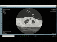Hémoptysie : cas radio-cliniques