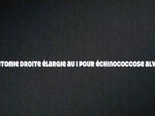 Hépatectomie droite élargie au segment I pour échinococcose alvéolaire Hépatectomie droite élargie au segment I pour échinococcose alvéolaire