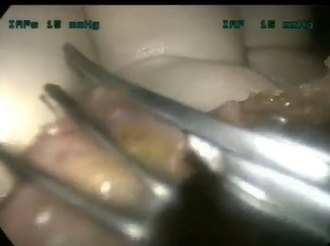 Hand-assisted Laparoscopic Surgery for Rectal Cancer