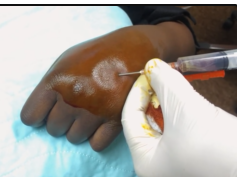 hand hematoma drainage