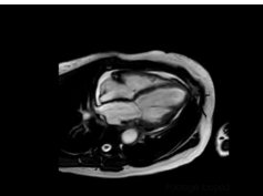 Heart Failure From Eosinophilic Granulomatosis With Polyangiitis (formerly Churg-Strauss Syndrome)
