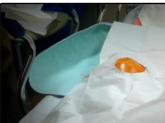 Hemarthrosis Drainage (Popping, Cysts, Boils and More!)