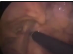 Hemorrhagic Intraoperative Complications in Laparoscopic Colorectal Surgery Hemorrhagic Intraoperative Complications in Laparoscopic Colorectal Surgery