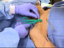 Hero Graft Placement: ISEVS Symposium 2019 Hero Graft Placement: ISEVS Symposium 2019