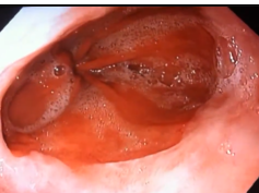 Hiatal Hernia Hill IV