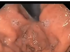 Hill Grade Iii Gastroesophageal Valve