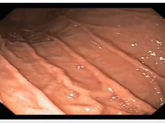 Hill Grade III/Grade IV Gastroesophageal Valve