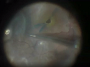 Hinged ILM Flap Technique for Repair of Failed Macular Hole Surgery