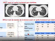 Histiocytose pulmonaire de l'enfant : quelles particularités, quels traitements ? Histiocytose pulmonaire de l'enfant : quelles particularités, quels traitements ?
