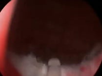 Holmium Laser Enucleation of the Prostate as Retreatment after UroLift Device