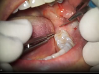 Horizontal Impacted Wisdom Tooth - Sonic Surgery