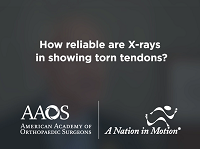 How reliable are X-rays in showing torn tendons? How reliable are X-rays in showing torn tendons?
