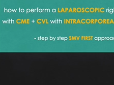 How to perform a lap right colectomy with CME and CVL with intracorporeal anastomosis How to perform a lap right colectomy with CME and CVL with intracorporeal anastomosis