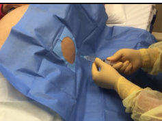 how to perform an abdominal fluid drainage procedure - Nurse Practitioner Student Mrs Starr