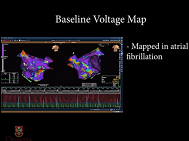Hybrid ablation under intraoperative 3D voltage mapping guidance