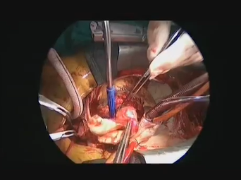 Hybrid Aortic Repair (MICHAEL J. REARDON, MD and ALAN B. LUMSDEN, MD) Hybrid Aortic Repair (MICHAEL J. REARDON, MD and ALAN B. LUMSDEN, MD)