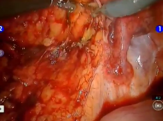 Hybrid Robotic Posterior Pelvic Clearance For Rectal Cancer