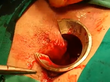 Hybrid Transanal and Hand?assisted Laparoscopic TME for Unexpected Low Rectal Cancer following TEM Hybrid Transanal and Hand?assisted Laparoscopic TME for Unexpected Low Rectal Cancer following TEM