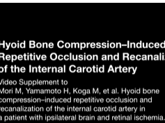 Hyoid Bone CompressionInduced Repetitive Occlusion and Recanalization of the Internal Carotid Arter Hyoid Bone CompressionInduced Repetitive Occlusion and Recanalization of the Internal Carotid Arter