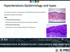 Hyperkeratosis in Dermatology: challenges and treatment