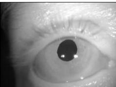 Hyperventilation-Induced Nystagmus Caused By Vestibular Schwannoma