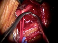 Hypoglossal Nerve Stimulator Implantation for Obstructive Sleep Apnea
