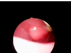 Hypopharyngeal Gastric Choristoma in a 7-Week-Old Infant