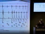 ICDs in Athletes ICDs in Athletes