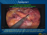 ICG image guided laparoscopic complete mesocolic excision with central vascular ligation ICG image guided laparoscopic complete mesocolic excision with central vascular ligation