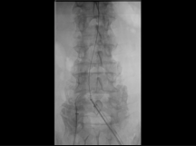 Iliac Branch Device and EVAR Iliac Branch Device and EVAR