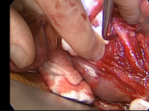 Iliac to SMA Bypass Ringed ePTFE Iliac to SMA Bypass Ringed ePTFE