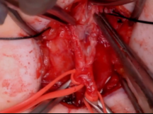 Iliofemoral Occlusion From ProGlide Iliofemoral Occlusion From ProGlide