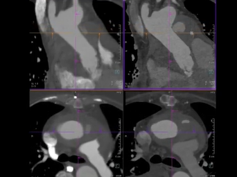 Image-guided Percutaneous Coil Embolization of Ascending Aortic Pseudo Aneurysm (A. Lumsden, MD) Image-guided Percutaneous Coil Embolization of Ascending Aortic Pseudo Aneurysm (A. Lumsden, MD)