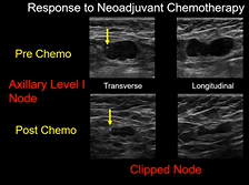 Imaging of neo adjuvant therapy in breast cancer treatment