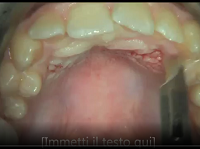 Impacted mesiodens extraction