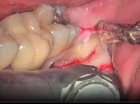 Impacted third molar conservative extraction and cyst removal