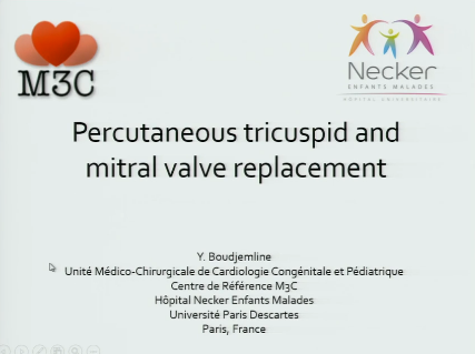 Implantation percutanée de valve mitrale ou tricuspide