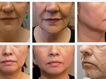 Improving Jowl Fat with Acid Injections. Plastic Surgery Hot Topics with Rod J. Rohrich, MD Improving Jowl Fat with Acid Injections. Plastic Surgery Hot Topics with Rod J. Rohrich, MD
