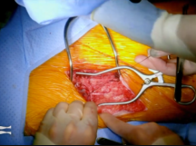 In Situ Femoral to Posterior Tibial Artery Bypass In Situ Femoral to Posterior Tibial Artery Bypass