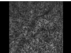 In Vivo Autofluorescence Imaging of Photoreceptors in Stargardt Disease Type 1 In Vivo Autofluorescence Imaging of Photoreceptors in Stargardt Disease Type 1