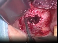 Incorrect Grafting Procedure