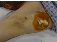 infected cyst drainage procedure
