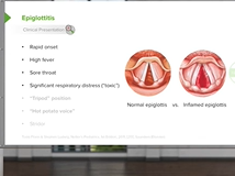 Infections of the Upper Pediatric Airway: Epiglottitis - Pediatric Infectious Diseases Infections of the Upper Pediatric Airway: Epiglottitis - Pediatric Infectious Diseases