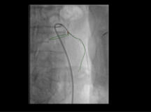 Inferior Mesenteric Artery Embolization Inferior Mesenteric Artery Embolization