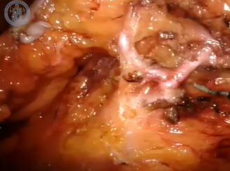 Inferior Mesenteric Artery Preserving Robotic Rectal Dissection