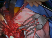 Inferior Mesenteric Artery Re-Implantation Inferior Mesenteric Artery Re-Implantation